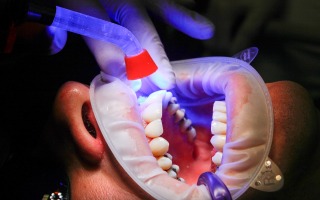 Dental Anomalies Among Childhood Cancer Survivors Differ According to Type of Anticancer Treatment Received